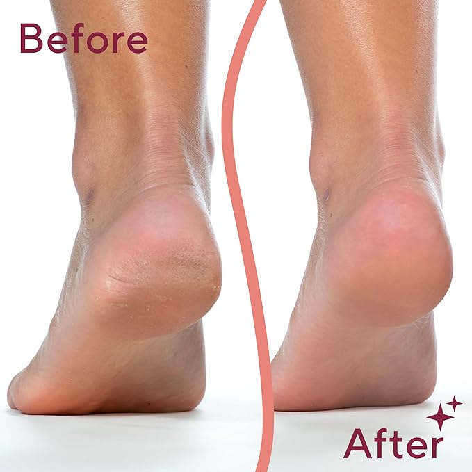 Flawless Pedicure Electronic File and Callus Remover