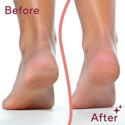 Flawless Pedicure Electronic File and Callus Remover